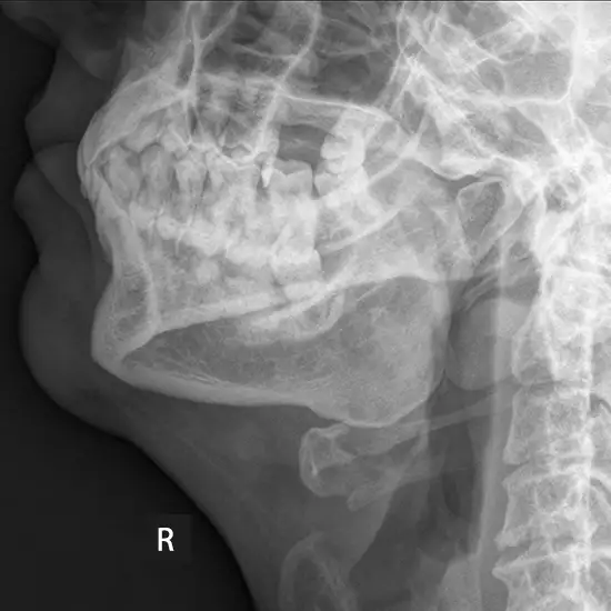x-ray mandible right lateral oblique view